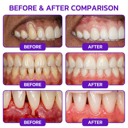 🦷【BOGO】Slimoly Bee Venom Toothpaste for Bleeding Gums & Periodontal Care👨‍⚕️