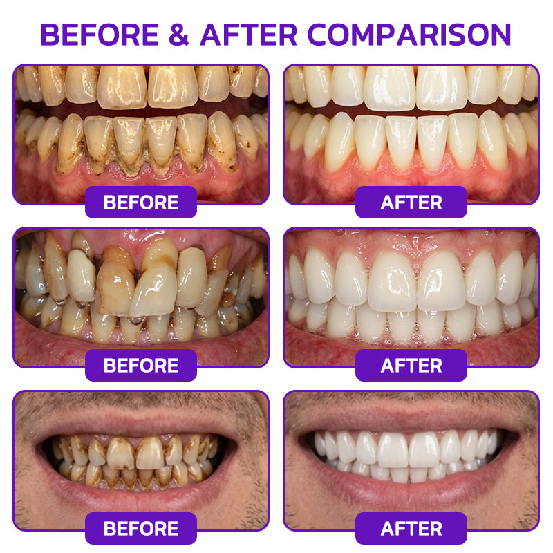 🦷【BOGO】Slimoly Bee Venom Toothpaste for Bleeding Gums & Periodontal Care👨‍⚕️