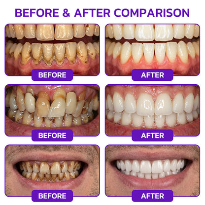 🦷【BOGO】Slimoly Bee Venom Toothpaste for Bleeding Gums & Periodontal Care👨‍⚕️